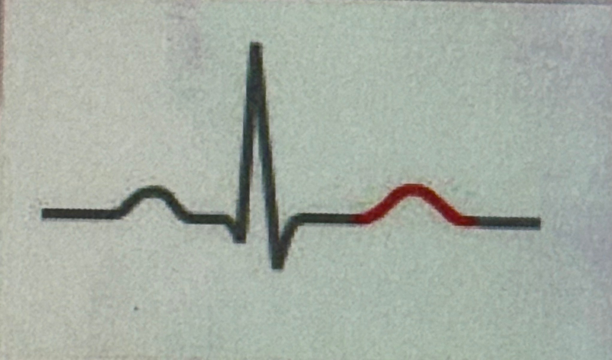 <p>ventricular relaxation (steady state)</p>