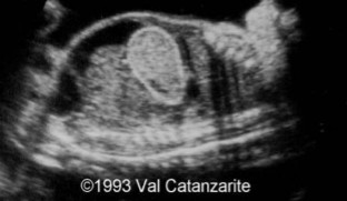 <p>Bowel obstruction has occurred in the fetus, and this was seen on the scan. </p><ol><li><p>What US finding is seen here?</p></li><li><p>What pathology is it an indication for?</p></li></ol><p></p>