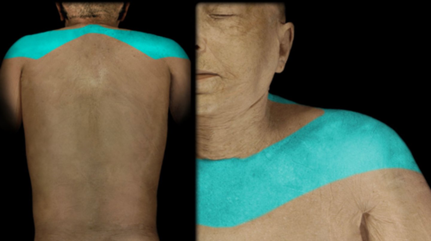 <p>Dermatome: Shoulder, clavicle, upper scap</p><p>Muscles innervated: Trap, Levator Scap</p><p>Reflexes (if any): None</p><p>Paresthesias: Clavicle and upper scap</p>