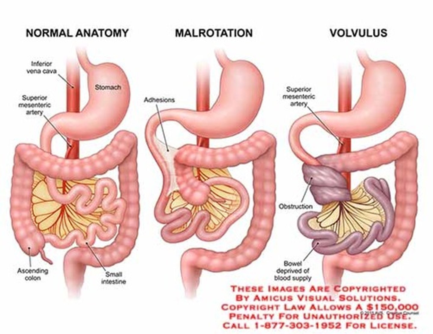<p>medical emergency!</p><p>- decompress, rehydrate, abx</p>