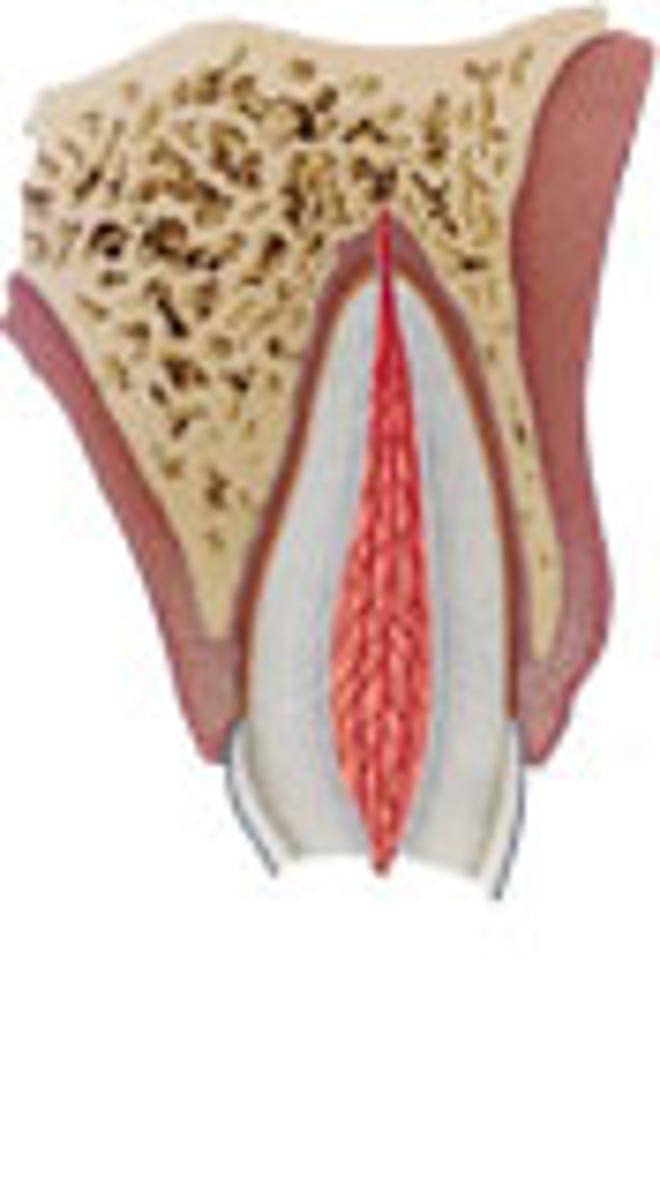 <p>fracture involving the enamel, dentin, and pulp exposure</p>