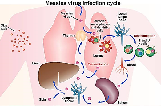 <p>By<strong> infection of lymphocytes and through viremia </strong>(free virus circulating in the blood).</p>