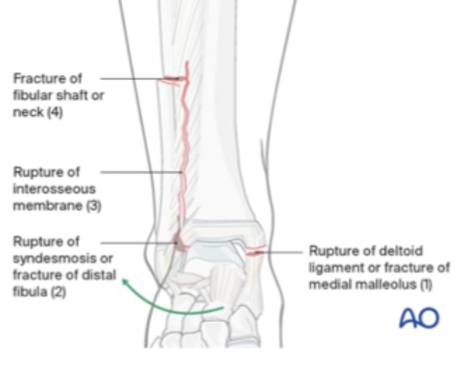 <p>A fracture of the 1/3 proximal fibula with associated isolated medial malleolus fracture OR a deltoid (medial) ligament injury (syndesmosis is screwed up as well)</p>