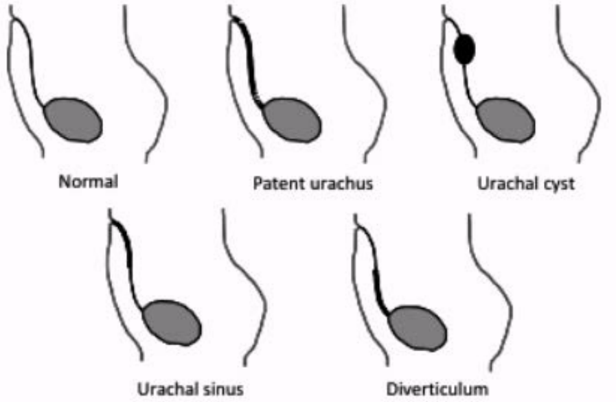 <ol><li><p>Completely patent urachus </p></li><li><p>Urachal cyst  </p></li><li><p>Urachal sinus </p></li><li><p>Urachal diverticulum </p></li></ol><p></p>