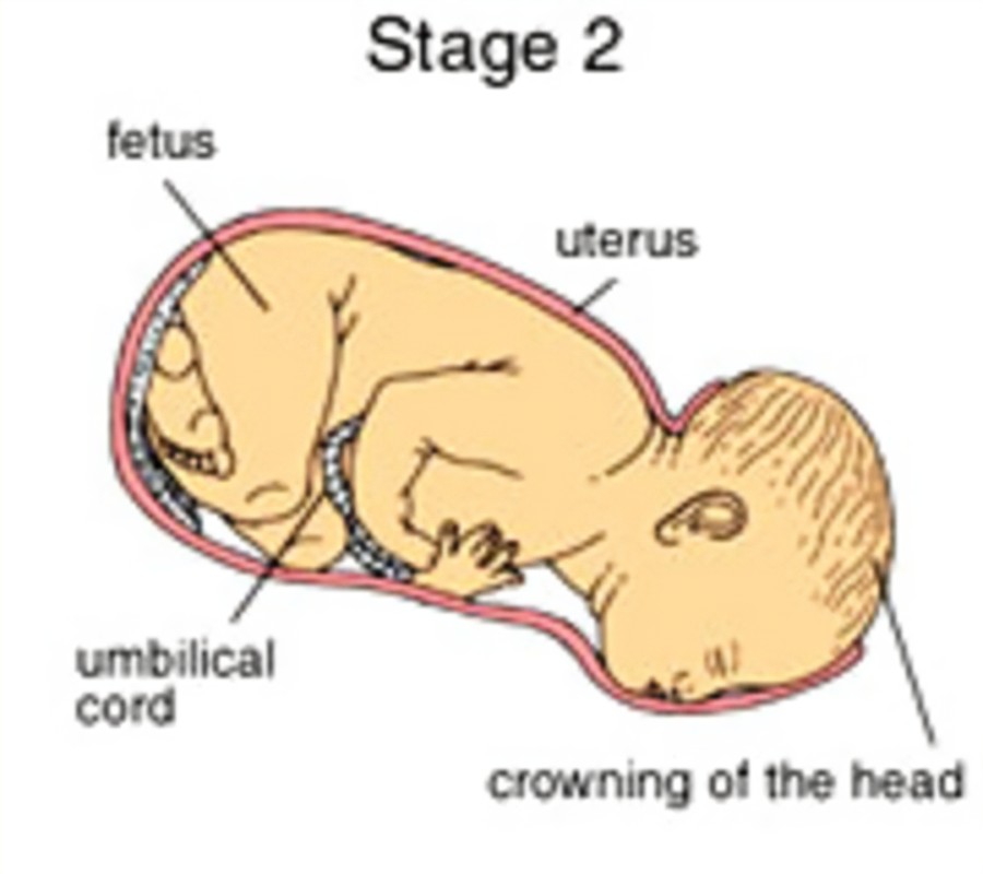 <p>Name and discuss the stage of labor that best describes the figure below:</p>