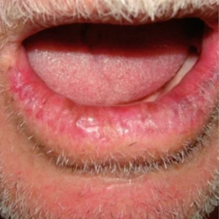 <p>what is this lesion </p>
