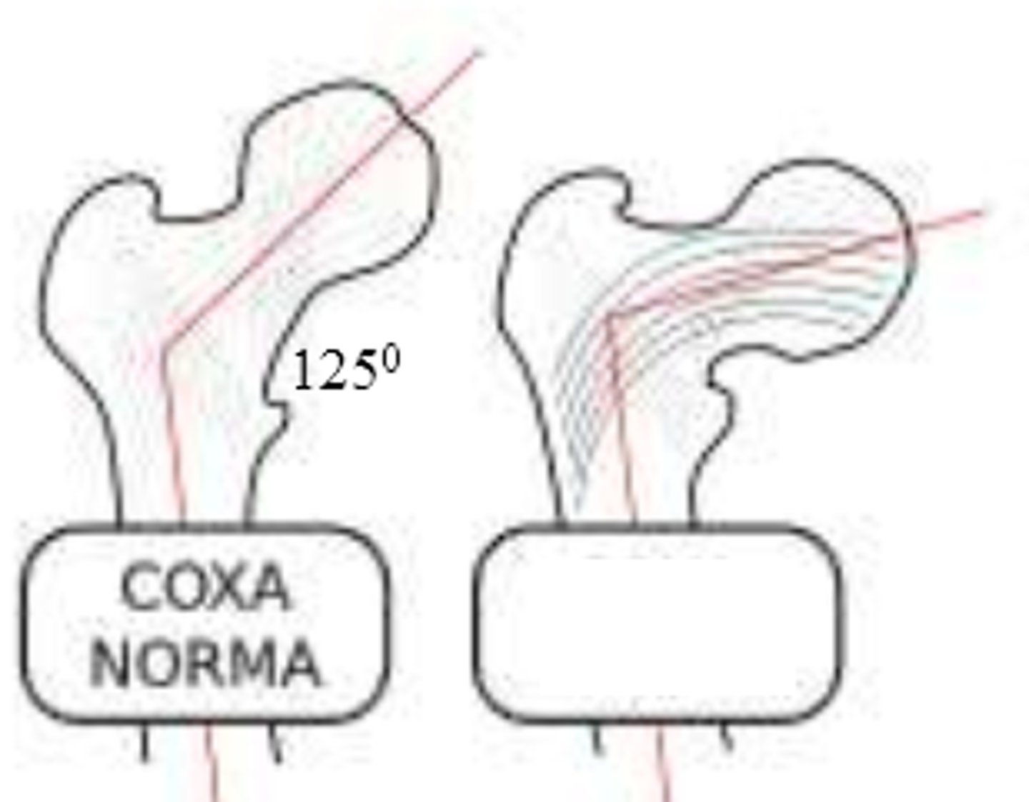 <p>development of femur with angle of inclination LESSER than expected</p><p>*involves femoral head/neck and shaft</p>