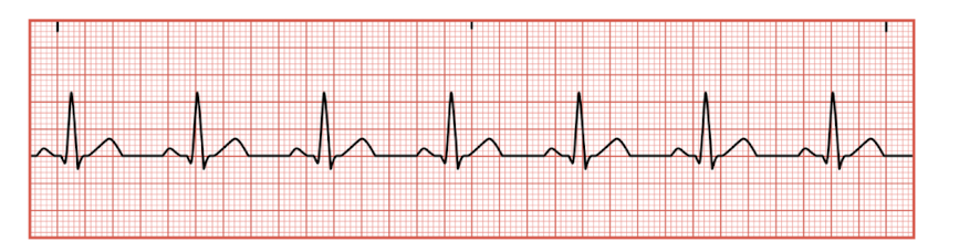 <p>normal conduction of the cardiac electrical</p><ol><li><p>SA node</p></li><li><p>AV node</p></li><li><p>Bundle of HIS</p></li><li><p>R+L bundle branches</p></li><li><p>Purkinje fibers&nbsp;</p></li></ol><p></p>