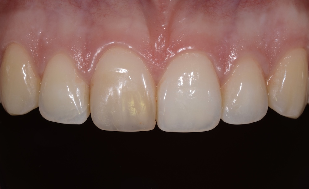 <p>Surface discoloration </p>