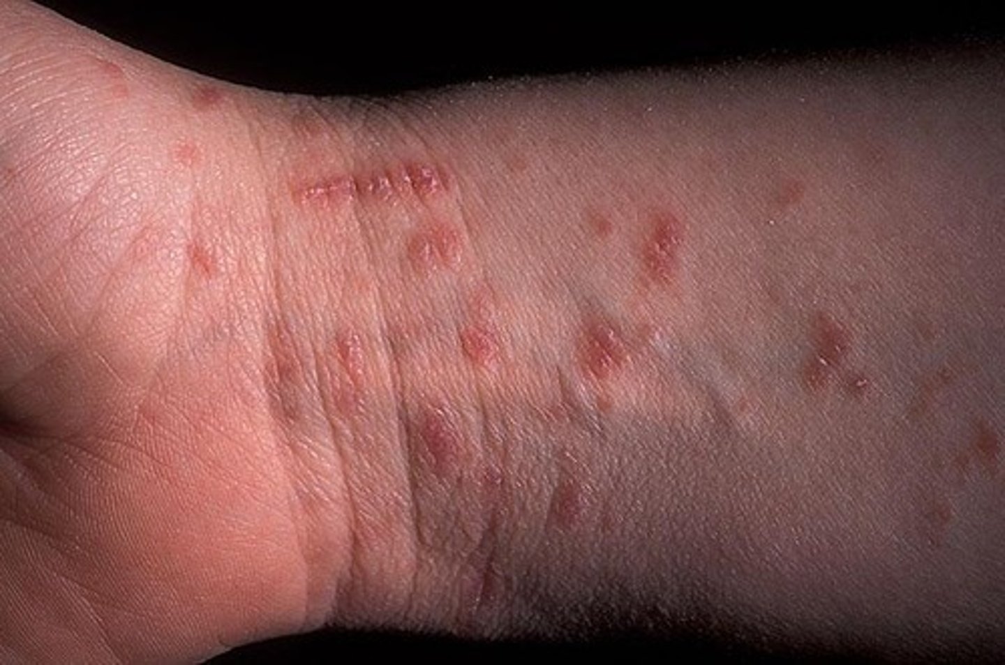 <p>what insect bite causes intense pruritus with burrows concentrated on web spaces, fingers, and toes?</p>