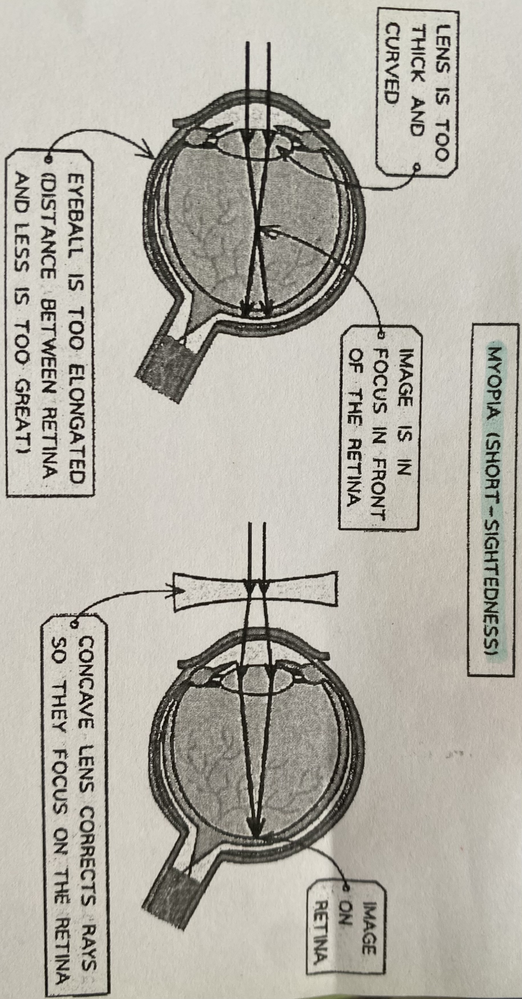 <p>When someone can see near objects closely but is unable to focus on distant objects</p><p class="has-focus">This is because the lens focuses light in front of the retina instead of on it. Short sightedness xan be caused by the eyeball being elongated or the lens being too thick or curved. Shortsightedness can be corrected by putting a concave lens in front of the eye</p>