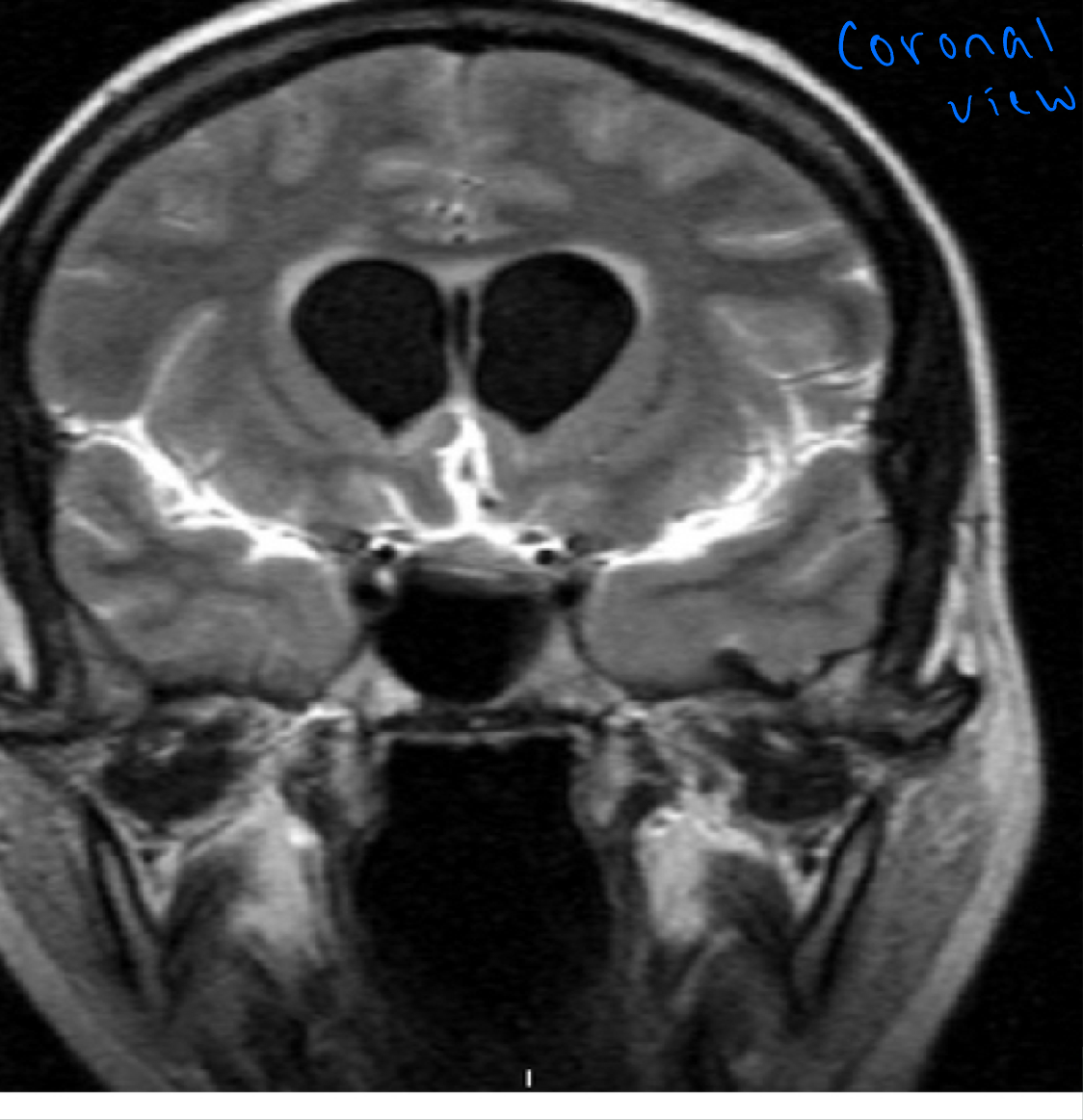 <p>Postcontrast. FLAIR MRI of a case of meningitis</p><p>Shows the enhancement of meninges at the tentorium and in the parietal region, with evidence of dilated ventricles</p>