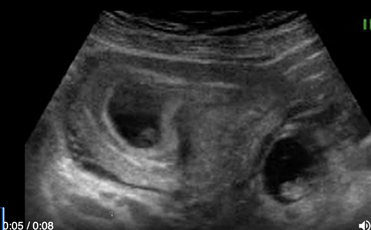 <p>a pt has higher than expected bHCG. her LMP was 8 weeks ago</p><p>a) normal twin pregnancy</p><p>b) heterotropic pregnancy</p><p>c) twin pregnancy in bicornuate uterus</p><p>d) twin pregnancy in septate uterus</p>