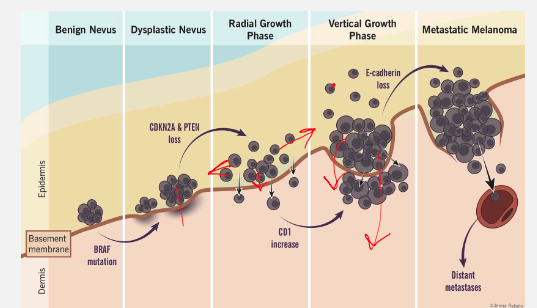<p><span>Benign Nevus:</span></p><p><span>What happens in a benign nevus?</span></p>