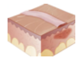 <p>Secondary Skin Lesion</p><ul><li><p><strong>Remnant</strong> of wound, usually found <strong>after surgery</strong></p></li><li><p>E.g., surgical site</p></li></ul><p></p>