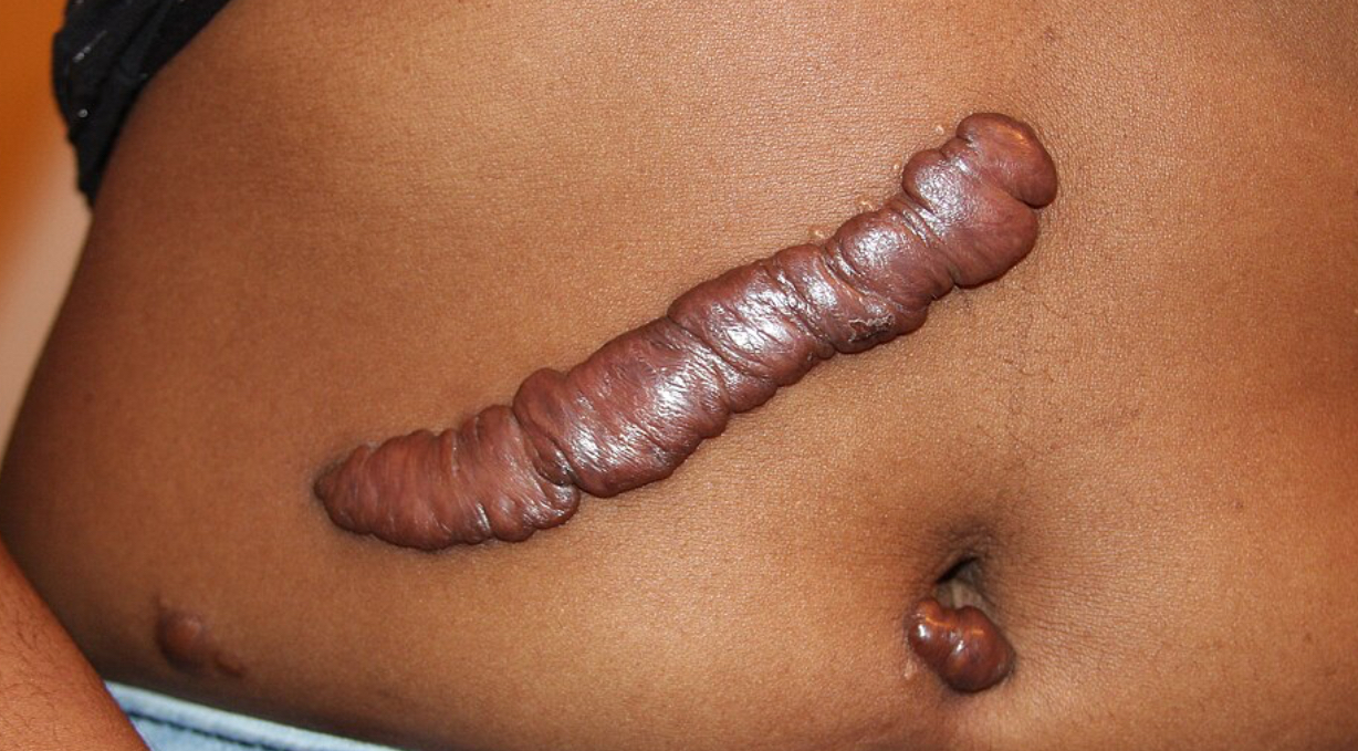 <p>Keloid</p>