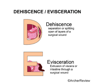 <ol><li><p>Dehiscence - separation or splitting open of layers of a surgical wound</p></li><li><p>Evisceration - extrusion of viscera or intestine through a surgical wound</p></li></ol><p></p>