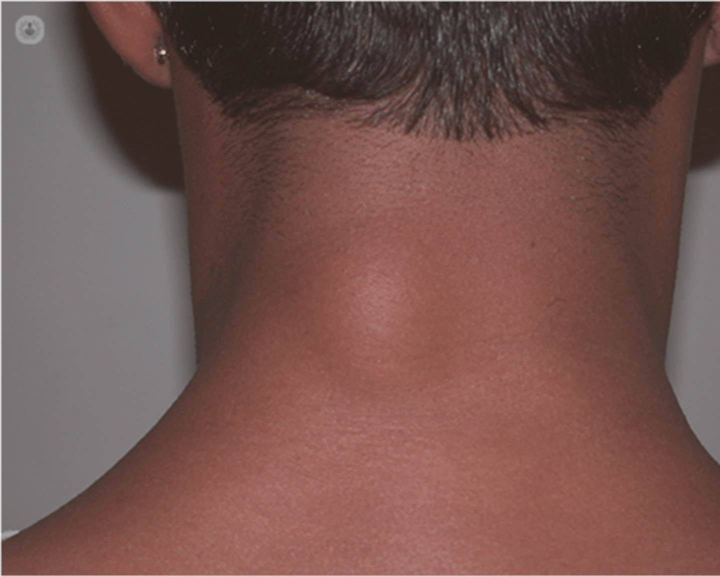 <p>name this skin pathology</p>