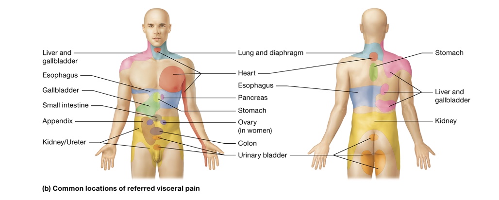 <p>referred pain</p>