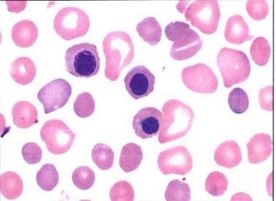 <p>This image of the blood smear from a newborn most likely represents</p><p>a severe G6PD deficiency</p><p>b hereditary spherocytosis</p><p>c untreated megaloblastic anemia</p><p>d HDN due to ABO incompatibility</p>