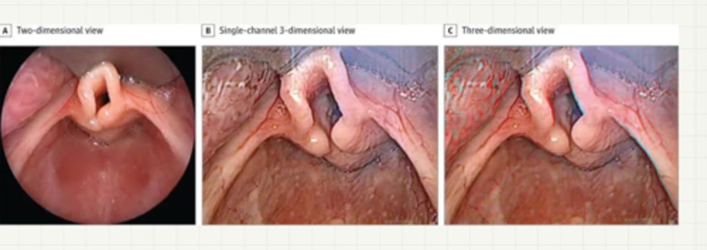 <p>laryngomalacia</p>
