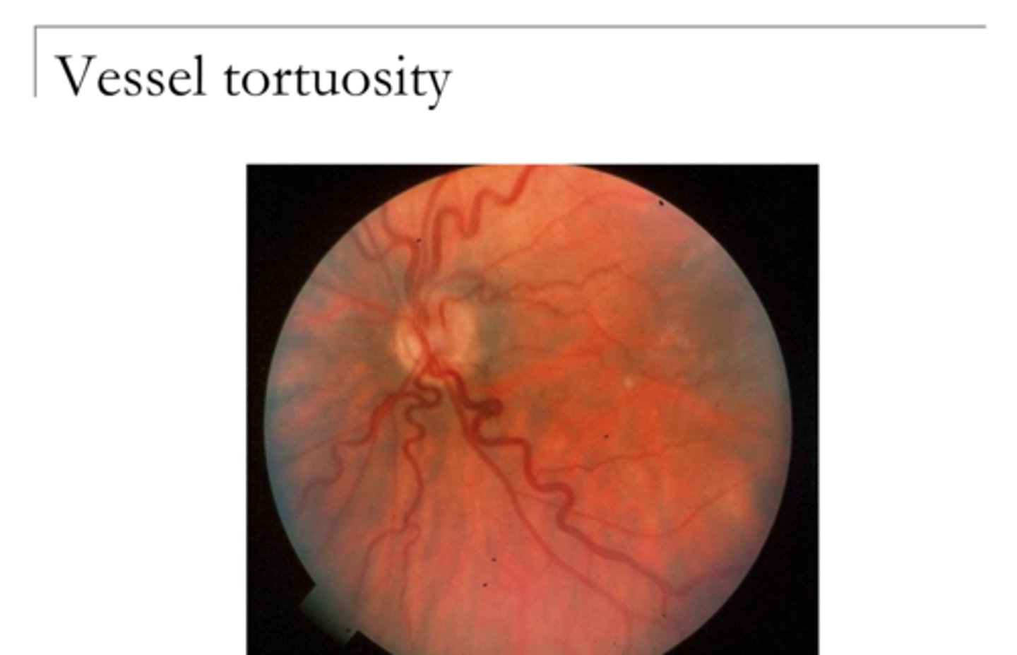 <p>Retinal Vessel Tortuosity (Pic)</p>