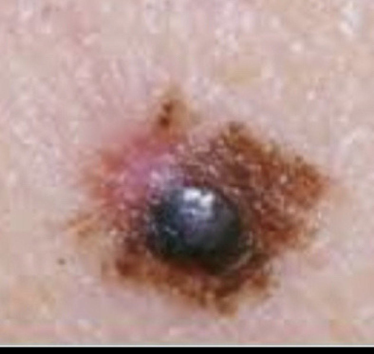 <p>Melanoma</p>