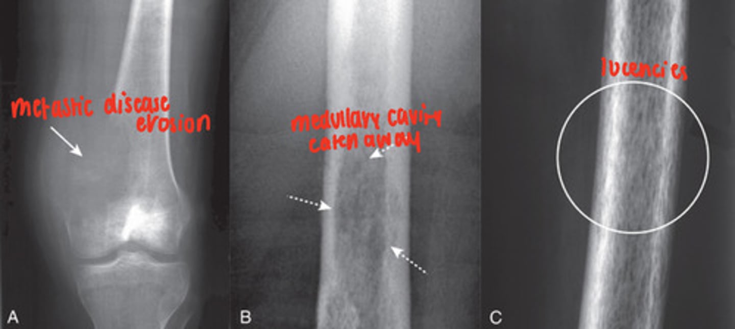 <p>malignancy spread causes bone destruction, mainly medullary cavity but cortex can be involved</p><p>MRI- excellent at demonstrating status of the medullary cavity</p><p>- irregularly shaped, lucent bone lesions</p>