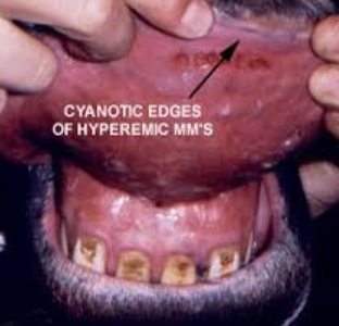 <p>-look for signs of systemic inflammation (increased HR, temp, RR)</p><p>-hyperemic mucus membranes</p><p>-dehydration</p><p>-edema</p><p>-complications of colitis</p>