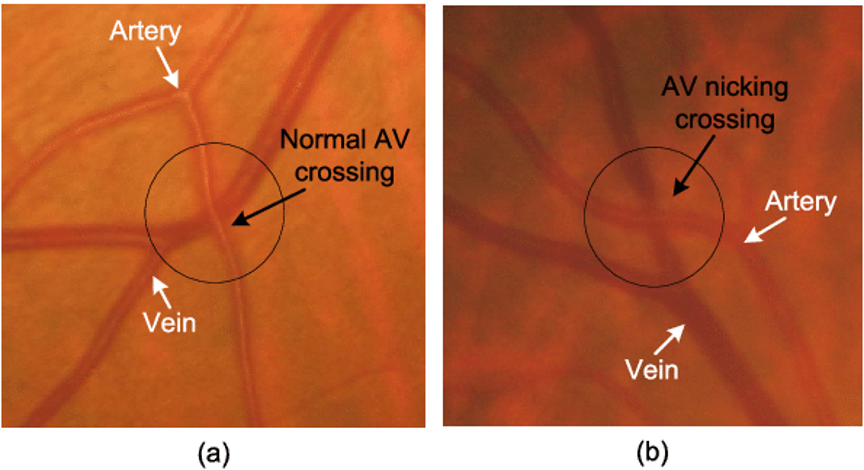 <ul><li><p>Atherosclerosis leading to venous nipping - <strong>most common</strong></p></li><li><p>Clots/emboli</p></li><li><p>Ischaemia</p></li><li><p>Vasculitis</p></li></ul><p></p>