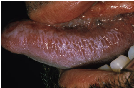<p>-Most prevalent in <strong>HIV</strong> pts; ALSO s/p <strong>organ</strong> <strong>transplant</strong></p><p>-Associated with <strong>EBV</strong> &amp; long term <strong>corticosteroid</strong> use</p><p>-Slightly raised areas develop rapidly on lateral border of tongue with "Hairy" surface</p><p>-Waxes and wanes, moderately irritative</p><p>-<strong>Acylovir/Valacyclovir</strong> for temp relief</p>