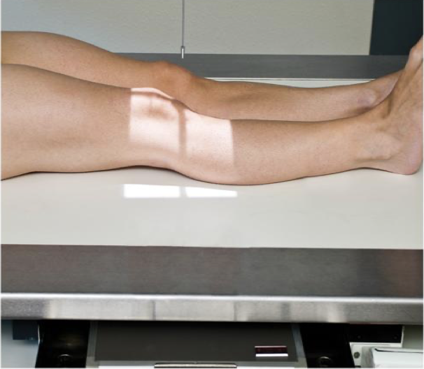 <p>Patient Position   </p><p class="p1"><span style="line-height: normal;"><span>• </span></span>Supine with no rotation</p><p class="p1"><span style="line-height: normal;"><span>• </span></span>Affected knee extended ( can be standing)</p><p class="p1"></p><p class="p1">Part Position</p><p class="p1"><span style="line-height: normal;"><span>• </span></span>Knee is in a true AP position</p><p class="p1"><span style="line-height: normal;"><span>• </span></span>Femoral epicondyles are in profile</p><ul><li><p class="p1"><span style="line-height: normal;"><span> </span></span>A line drawn between the epicondyles is parallel to the IR</p></li></ul><p class="p1"><span style="line-height: normal;"><span>• </span></span>Leg internally rotated ≈ 3-5°</p><p class="p1"></p><p class="p1">CR</p><p class="p1"><span style="line-height: normal;"><span>• </span></span>CR is parallel to the tibial plateau</p><ul><li><p class="p1"><span style="line-height: normal;"><span> </span></span>Amount of CR angle required depends on thickness of patient’s thighs (See below)</p></li></ul><p class="p1"><span style="line-height: normal;"><span>• </span></span>CR is centered 1.25 cm inferior to the apex of the patella</p><p class="p1"></p><p class="p1">Collimation</p><ul><li><p class="p1">Include about ¼ of distal femur + proximal tib/fib</p></li></ul><p></p>