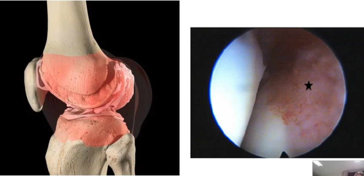 <ul><li><p>A <strong>thin, slippery fluid</strong> that is similar in appearance and consistency to uncooked egg white</p></li><li><p>It occupies the <strong>joint cavity</strong> and acts as a <strong>lubricant between the joint surfaces</strong> (surfaces of the articular cartilage)</p></li><li><p>The primary purpose of the synovial fluid is to <strong>reduce friction between the articulating surfaces</strong>; however, it also <strong>nourishes the articular cartilage</strong></p></li></ul><p></p>