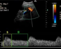 <p>The patient dopplered on is at 28 weeks’ gestation. This is the uterine artery.</p><ol><li><p>Is this waveform normal for how far they are?</p></li><li><p>If not, what could this indicate?</p></li></ol><p></p>