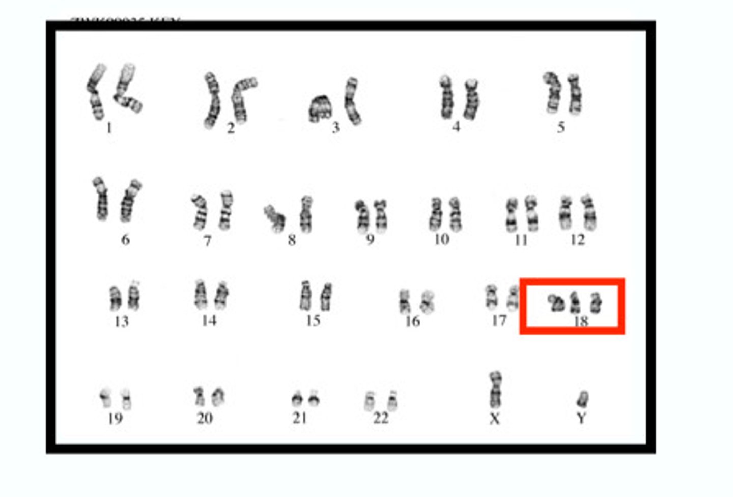 <p>condition when an individual has three number 18 chromosomes, resulting in Edwards syndrome</p>