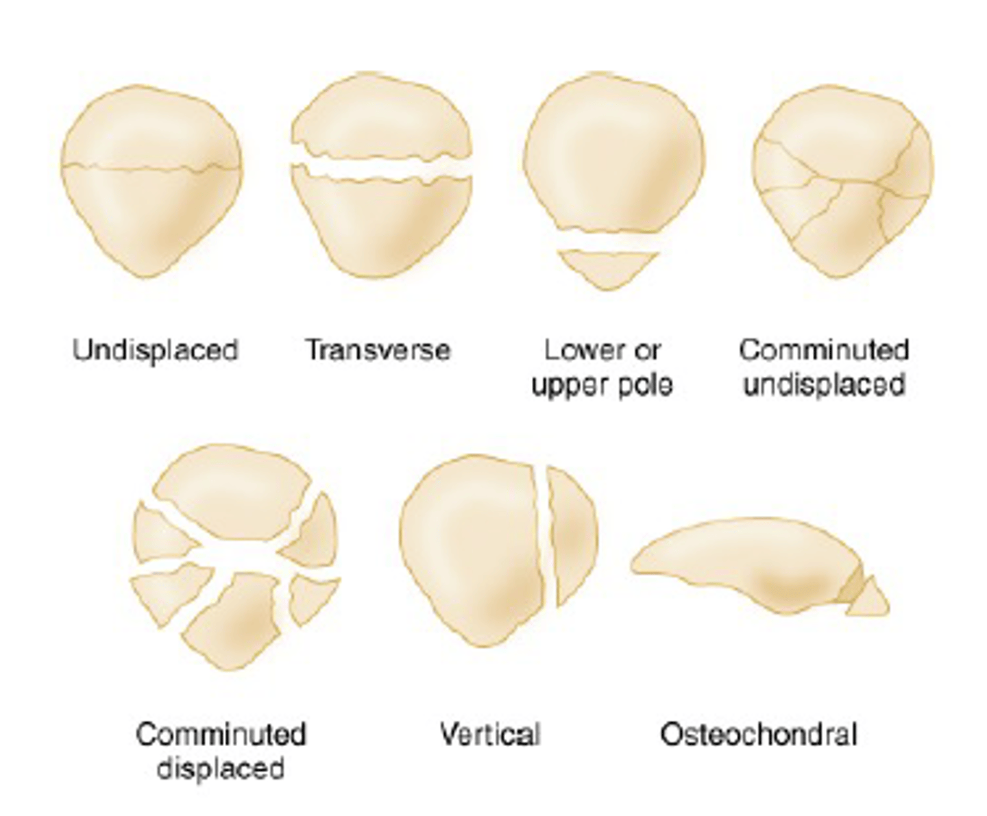 <p>knee pain following blunt trauma</p><p>XR with merchant/sunrise view</p>
