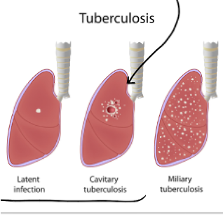 <p>in<span style="font-family: &quot;Times New Roman&quot;; line-height: normal; font-size: 7pt;"> </span><span>fection causes delayed HS reaction type IV, creating caseating (central necrosis) granulomas, can do to any organ</span></p><p class="MsoListParagraphCxSpMiddle"><span style="font-family: &quot;Courier New&quot;;">o</span><span style="font-family: &quot;Times New Roman&quot;; line-height: normal; font-size: 7pt;">&nbsp;&nbsp; </span><span>Scrofula: TB in cervical lymph nodes</span></p><p class="MsoListParagraphCxSpMiddle"><span style="font-family: &quot;Courier New&quot;;">o</span><span style="font-family: &quot;Times New Roman&quot;; line-height: normal; font-size: 7pt;">&nbsp;&nbsp; </span><span>Pott disease: TB in vertebrae</span></p><p class="MsoListParagraphCxSpLast"><span style="font-family: &quot;Courier New&quot;;">o</span><span style="font-family: &quot;Times New Roman&quot;; line-height: normal; font-size: 7pt;">&nbsp;&nbsp; </span><span>Miliary TB: no central necrosis</span></p>