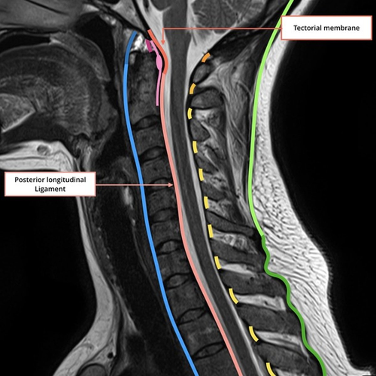 <p>Location</p><p>• Superiorly, connects C2 to the intracranial aspect of the base of the skull (aka Tectorial Membrane)</p><p>• Travels inferiorly inside the vertebral canal, along the posterior surface of the vertebral bodies.</p><p>• Goes from Atlas to Sacrum.</p><p>• Like A.L.L., attaches to vertebral bodies and discs along its length.</p><p>Responsibility</p><p>• Prevents hyperflexion of the vertebral column</p>
