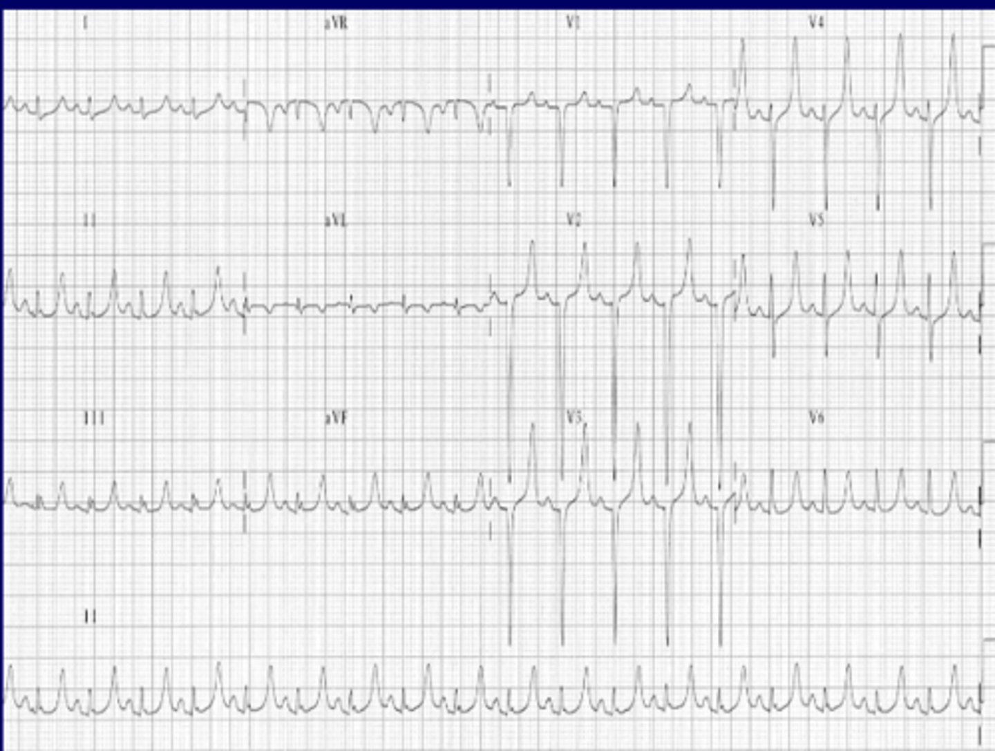 <p>hyperkalemia</p>
