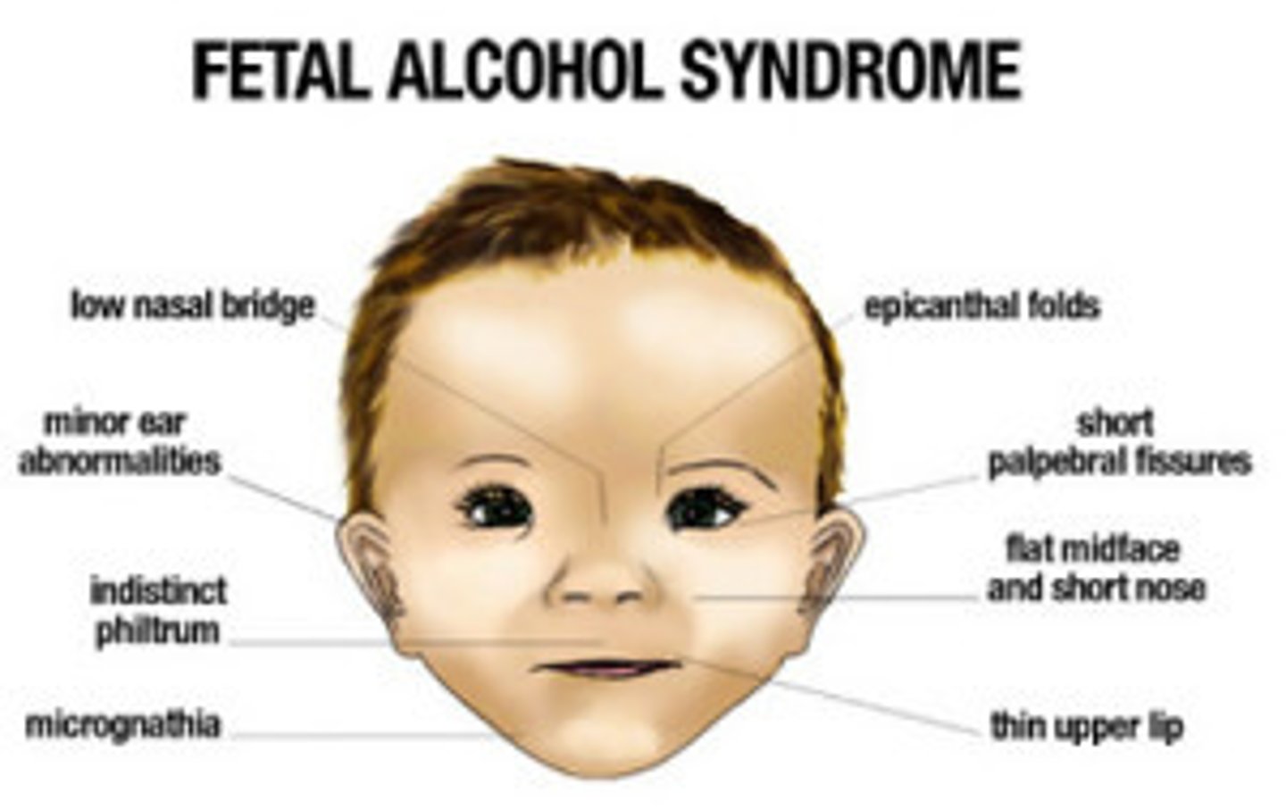 <p>condition caused by excessive alcohol consumption by the mother during pregnancy</p>