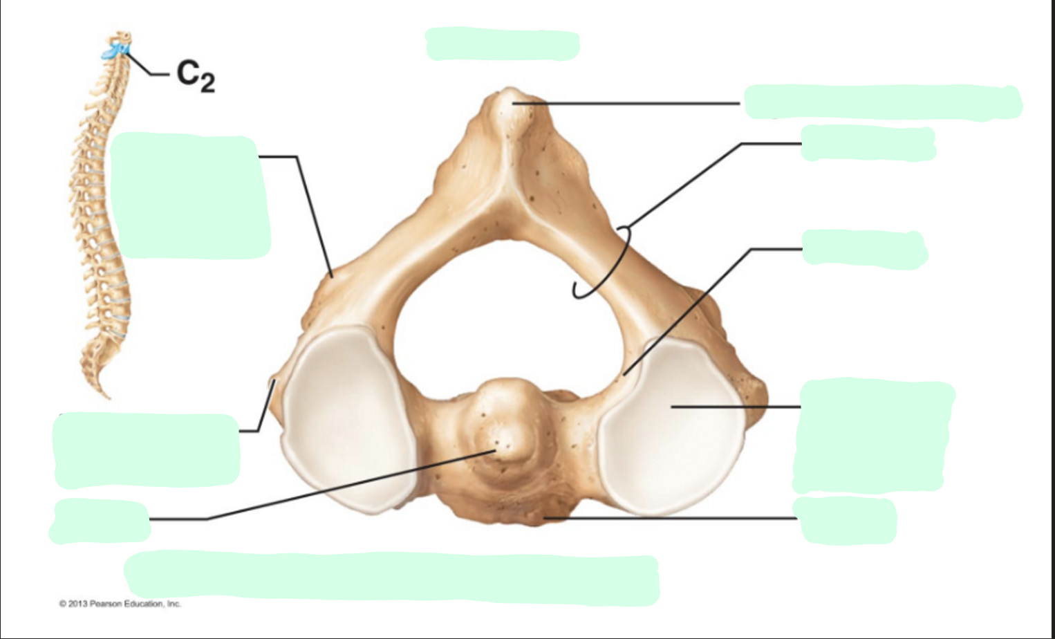 <p>Where is the<strong> Spinous Process </strong>of the axis?</p>