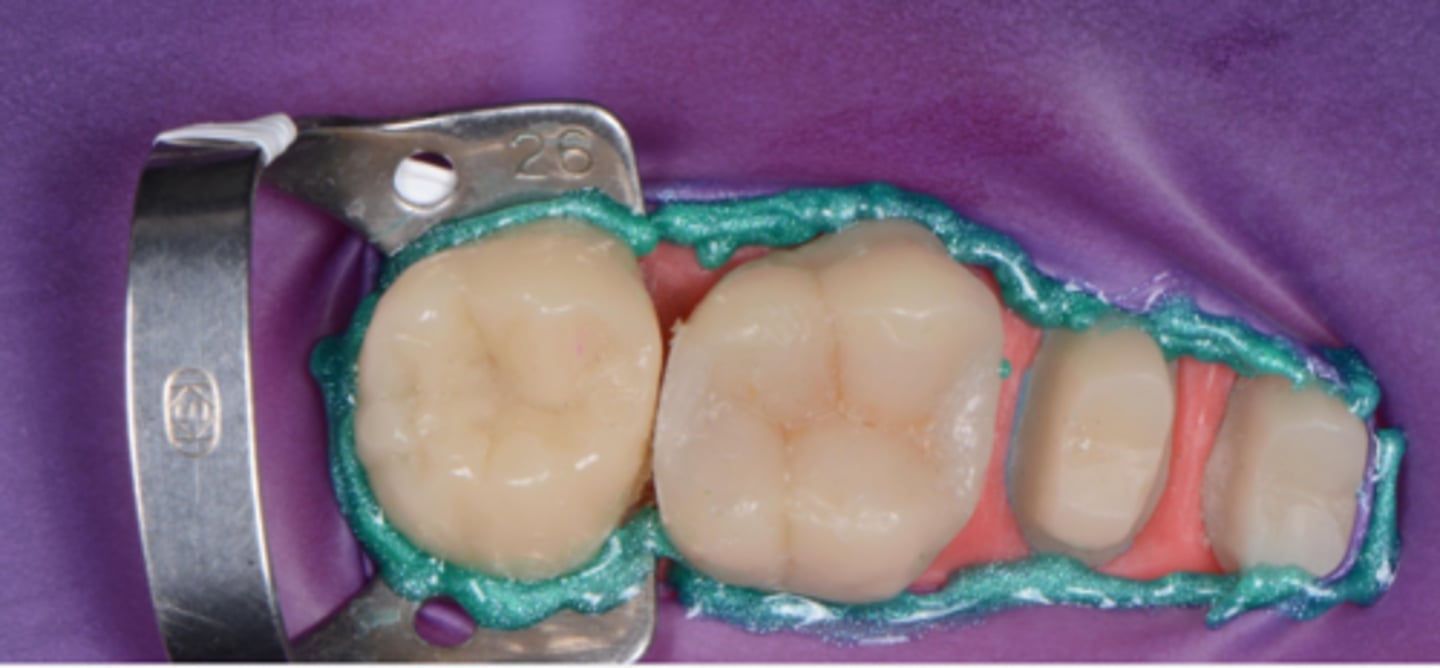 <p>What is placed around the teeth, shown in teal?</p>