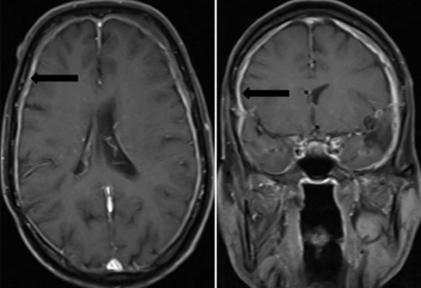<p>What would you see on a Brain MRI with Gadolinium in a pt with Meningitis?</p>