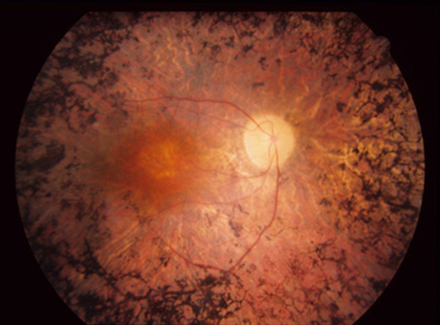 <p>What are 2 possible complications of <strong>RP</strong>?</p>