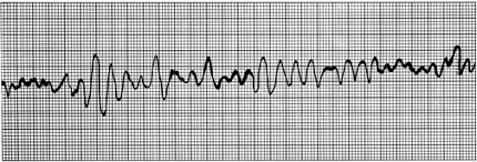 <p><span><span>No identifiable rhythm</span></span></p><p style="text-align: left;"></p><p style="text-align: left;"><span><span>Sustained = Emergency</span></span></p>