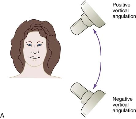 <p>#1 shows INCORRECT vertical angulation</p><ul><li><p>it is over angulated thus obstructing the interproximal view of the lesion</p></li></ul><p>#2 shows CORRECT vertical angulation</p><ul><li><p>interproximal caries now visible on the radiograph. </p></li></ul><p>**vertical angulation = tilting PID up or down </p><p></p>
