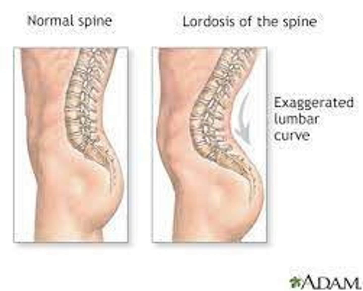<p>Over-pronounced curvature of the lumbar spine, frequently seen in pregnant women and obese people, also known as 'Swayback'.</p>