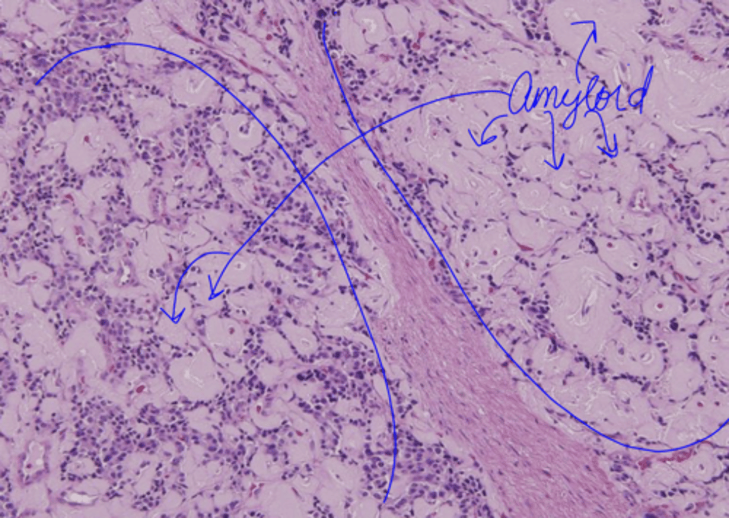 <p>deposition of amyloid</p>