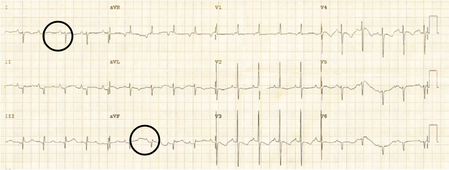 <p>both I and aVF mostly neg deflected</p>