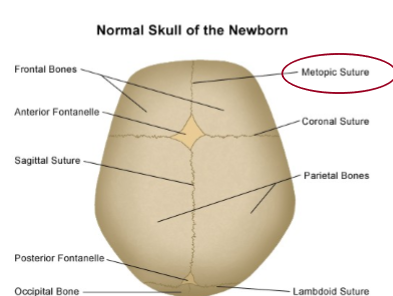 <p>premature fusion of the <strong><u>metopic </u></strong>suture </p>
